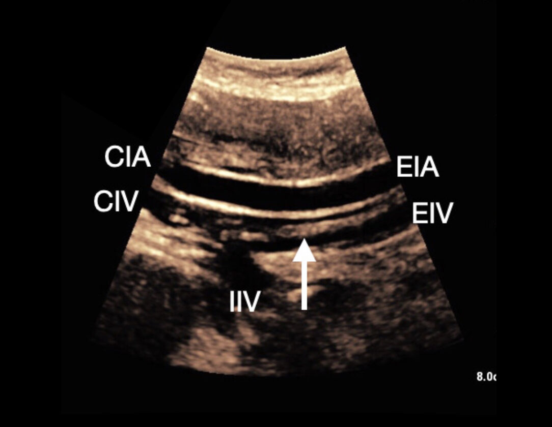 Ultrasound Optimization session